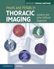 [PDF] Pearls and Pitfalls in Thoracic Imaging: Variants and Other Difficult Diagnoses 1st Edition (2011) by Thomas Hartman