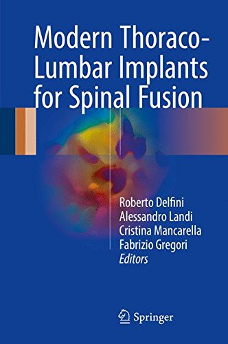 [PDF] Modern Thoraco- Lumbar Implants for Spinal Fusion (2017) by Roberto Delfini