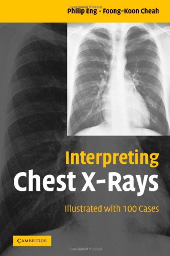 [PDF] Interpreting Chest X-Rays: Illustrated with 100 Cases 1st Edition (2005) by Philip Eng