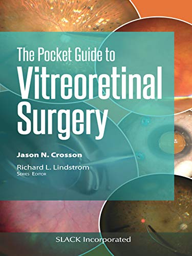 [PDF] Pocket Guide to Vitreoretinal Surgery (Pocket Guides) 1st Edition (2020) by Jason N. Crosson