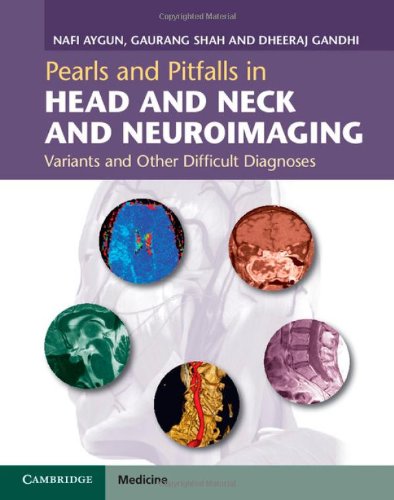 [PDF] Pearls and Pitfalls in Head and Neck and Neuroimaging: Variants and Other Difficult Diagnoses 1st Edition (2014) by Nafi Aygun