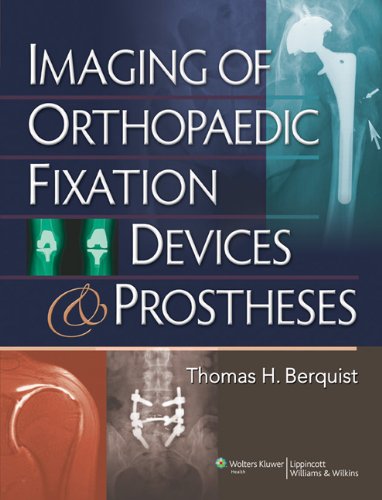 [PDF] Imaging of Orthopaedic Fixation Devices and Prostheses (2009) by Thomas H. Berquist