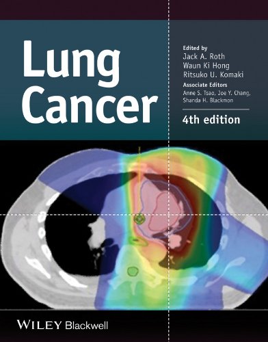 [PDF] Lung Cancer 4th Edition (2014) by Jack A. Roth