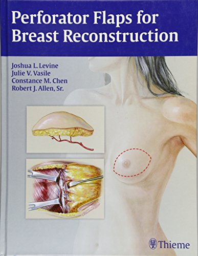 [PDF] Perforator Flaps for Breast Reconstruction (2016) by Joshua L. Levine