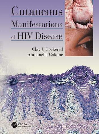 [PDF] Cutaneous Manifestations of HIV Disease (2012) by Clay Cockerell, Antoanella Calame