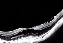 Handbook of Retinal OCT: Optical Coherence Tomography 1st Edition (2013) by Jay S. Duker PDF