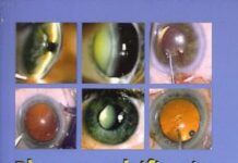 Phacoemulsification Made Easy (2005) by Aasheet H. Desai PDF