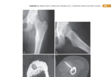 Campbell’s Operative Orthopaedics – Volume 2 (2017) Frederick M. Azar