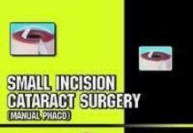 Small Incision Cataract Surgery – Manual Phaco (2002) Kamaljeet Singh