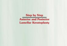 Step by Step Anterior and Posterior Lamellar Keratoplasty (2006) Thomas John