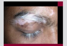 Comprehensive Textbook on Vitiligo (2021) Vineet Relhan