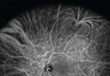 Choroidal Disorders (2017) Jay Chhablani
