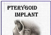 PTERYGOID IMPLANT – Glimpse of hope for management of atrophic maxilla (2021) Dr. Pallavi D. Yawale