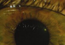 Vitrectomy (2012) Zongming Song