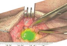 Clinical Lymphatic Mapping in Gynecologic Cancers (2022) Charles F. Levenback