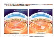 Cirugía de Catarata Manual Moderna de Pequeña Incisión – Pasos de la Técnica Mini Nuc (2005) Michael Blumenthal, M.D.