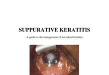 SUPPURATIVE KERATITIS – A guide to the management of microbial keratitis (2005) Edith Ackuaku